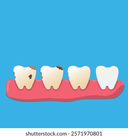 The vector of four teeth depicts teeth starting to turn yellow to yellow and hollow teeth