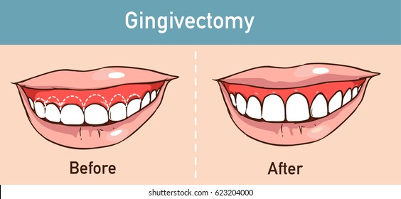  vector illüstration of a Gingivectomy 