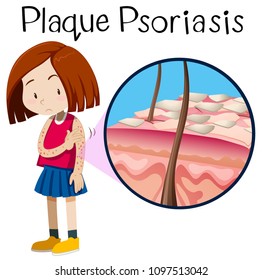 A Vector Of Girl Plaque Psoriasis Illustration