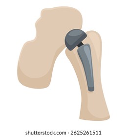 Vector graphic of a hip joint replacement, showcasing a medical prosthetic implant