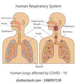 Vector graphic illustration of human respiratory system and human lungs affected by covid