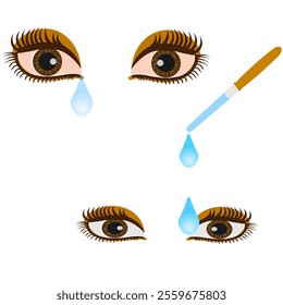 Vector graphics. Brown, reddened eyes with tears. Eye drops drip from a pipette into the eye.