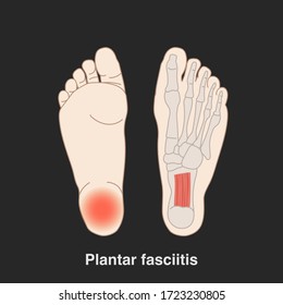 Vector hand drawn flat illustration plantar fasciitis infographic for medical studies. Isolated on black background.