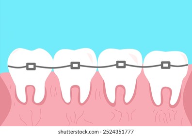 Vetor Chaves saudáveis com gomas agradáveis. Problemas Orais Médicos. Limpeza do esmalte. Isolado no plano de fundo azul claro. Ilustração de vetor para aparelhos dentários humanos