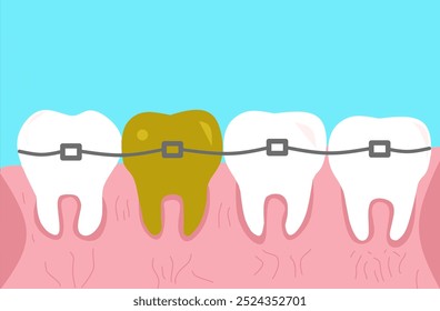 Vector Healthy Braces with nice Gums. Medical Dental Oral Problems. Enamel Cleanliness. Isolated on light blue Background. Vector Illustration of Rotting Human Braces