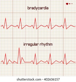 Vector - Heart beats cardiogram 