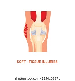 Vector of Human Diagnosis of Soft Tissue Injury Disease