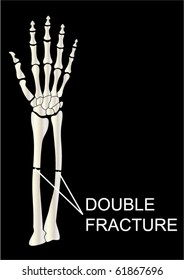 vector human hand bones with double fracture