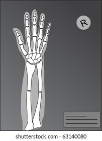 vector human hand roentgen and fracture