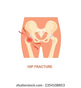 Vector of Human Hip Fracture Diagnosis