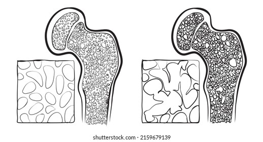 The vector of human, Humerus bone osteoporosis.
-Osteoporosis causes bones to become weak and brittle so brittle that a fall or even mild stresses such as bending over or coughing can cause a fracture