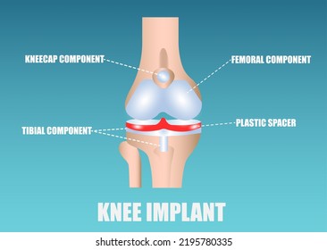 Vector Of A Human Knee Implant