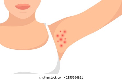 Vector hyperhidrosis armpits illustration. 2d women deodorant care skin. Epilation and depilation armpits. Hair removal procedures. Laser waxing. Female hairy problems zone. Smelly skin symbol svg