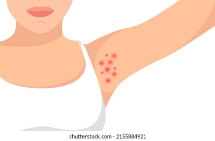 Vector hyperhidrosis armpits illustration. 2d women deodorant care skin. Epilation and depilation armpits. Hair removal procedures. Laser waxing. Female hairy problems zone. Smelly skin symbol