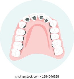 vector icon of lower jaw with dental braces. Braces advertising concept.