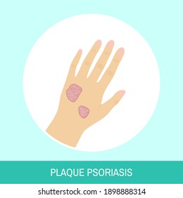 Vector illuctration "Plaque psoriasis". Circle icon with text sign. Image of female hand with plaque psoriasis top view for medical articles, posters and banners.