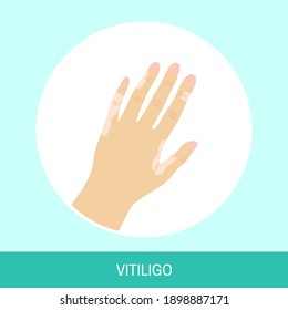 Vector illuctration "Vitiligo". Circle icon with text sign. Image of female hand with vitiligo top view for medical articles, posters and banners.
