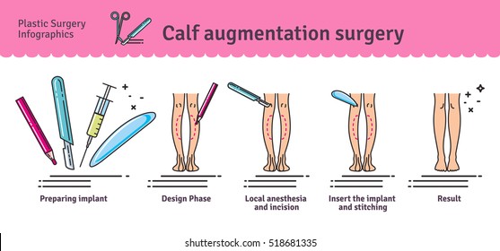 Vector Illustrated set with calf augmentation surgery. Infographics with icons of plastic surgery procedures.