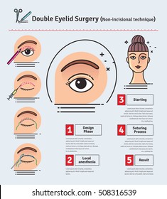 Vector Illustrated set with double eyelid surgery. Non-incisional technique. Infographics with icons of plastic surgery procedures.