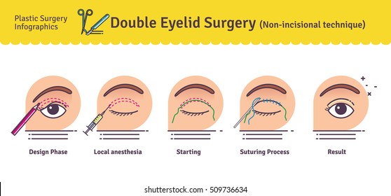 Vektorgrafik-Set mit doppelter Augenlidoperation. Nicht-Inzisionstechnik. Infografiken mit Symbolen der plastischen Chirurgie.