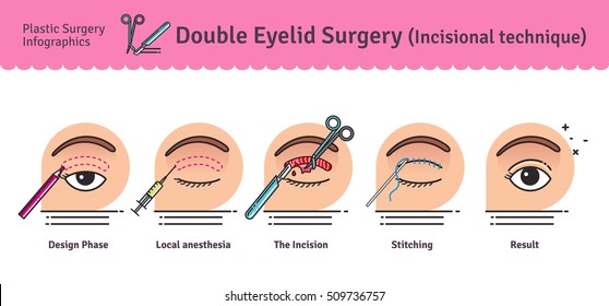 Vector Illustrated set with double eyelid surgery. Infographics with icons of plastic surgery procedures.