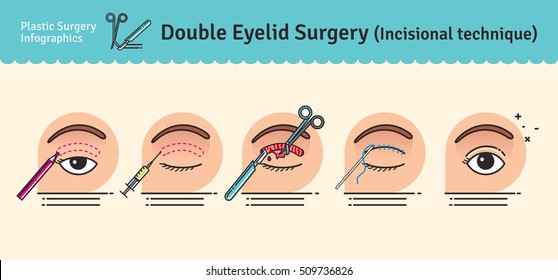 Vector Illustrated set with double eyelid surgery. Infographics with icons of plastic surgery procedures.