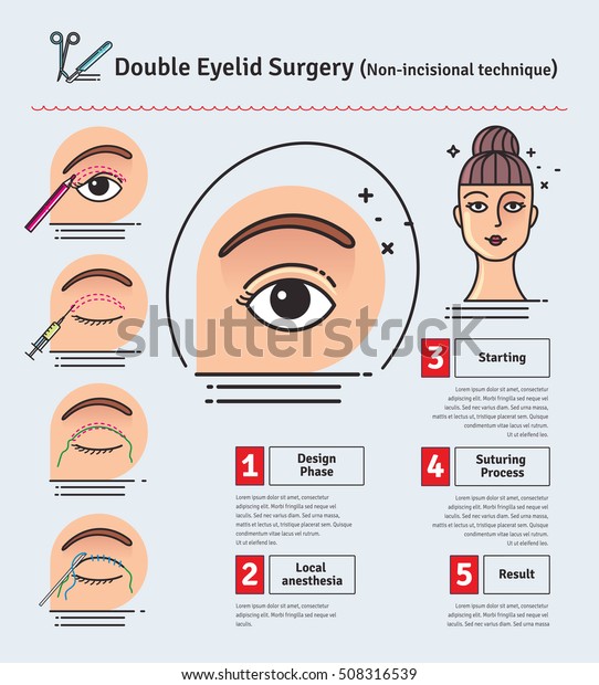 double eyelid surgery procedure