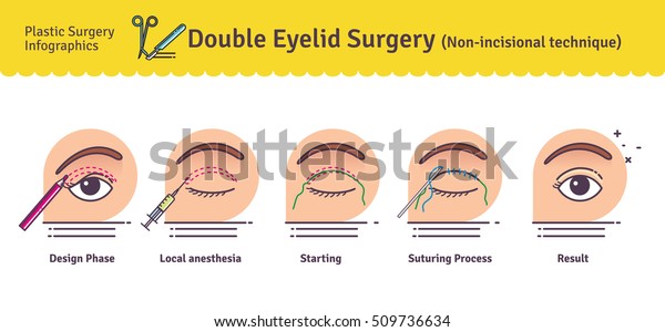 二重まぶた手術を伴うベクターイラストセット 非切開技術 整形手術のアイコンとインフォグラフィック のベクター画像素材 ロイヤリティフリー