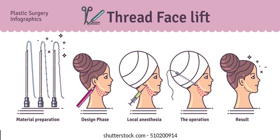 Vector Illustrated set with face lifting surgery by thread. Infographics with icons of plastic surgery procedures.