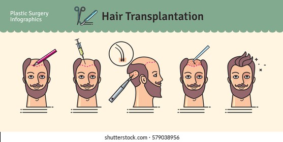 Vector Illustrated set with hair transplant surgery. Infographics with icons of plastic surgery procedures.