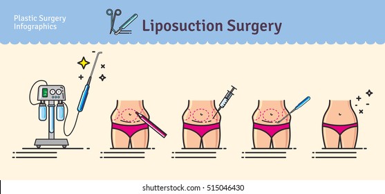 Vector Illustrated set with liposuction surgery. Infographics with icons of plastic surgery procedures.