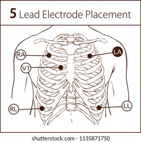 Vector Illustration Of A 5 Lead Electrode Placement