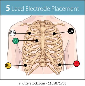 Vector Illustration Of A 5 Lead Electrode Placement