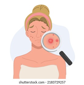 vector illustration about Acne skin problems Concept.  woman with magnifying glass is looking acne on her facial. 

