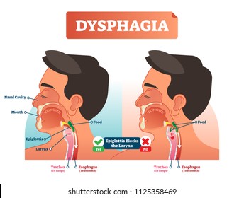 Vector illustration about dysphagia. Human compered in scheme. Closeup head with nasal cavity, mouth, tongue, trachea to lungs and esophagus to stomach. Explained how epiglottis blocks the larynx.