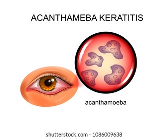 vector illustration of acanthamoebic keratitis. infectious inflammation of the eyelids