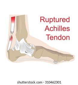 Vector Illustration Achilles Tendon Rupture Image Stock Vector (Royalty ...