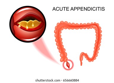 vector illustration of acute appendicitis, the inflammation of the Appendix
