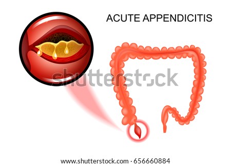 vector illustration of acute appendicitis, the inflammation of the Appendix