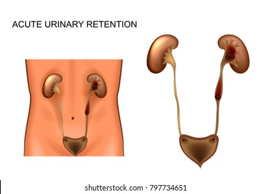 Vector Illustration Of Acute Urinary Retention. Kidney Stones