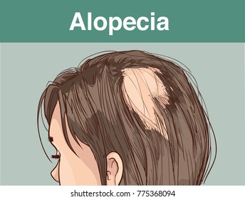  vector illustration of aFemale alopecia