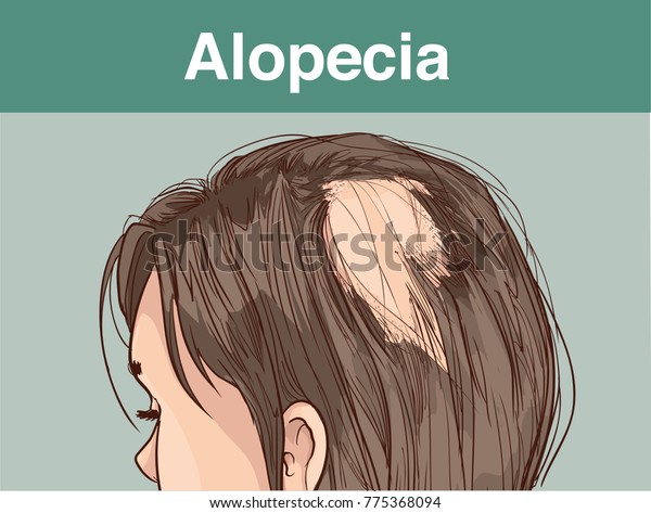 Vector Illustration Afemale Alopecia Stock Vector Royalty Free 775368094