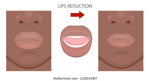 Vector illustration. African American Lips reduction before and after procedure. Close up view. For advertising of medicinal, pharmacy products, cream, lotion, cosmetic and plastic procedures. EPS 10.