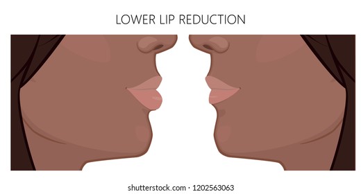 Vector illustration. African American lower lip reduction before, after procedure. Close up view. For advertising of cosmetic plastic procedures; for medical and beauty publications. EPS 10.