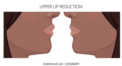 Vector illustration. African American upper lip reduction before, after procedure. Close up view. For advertising of cosmetic plastic procedures; for medical and beauty publications. EPS 10.