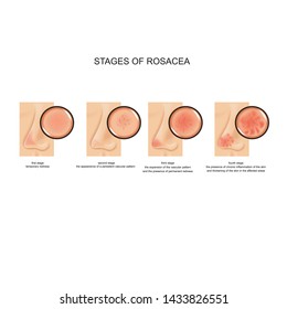 vector illustration of all four stages of rosacea