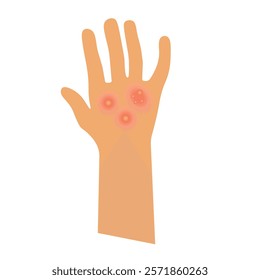 vector illustration of allergen on the hand. Acne, allergy, skin rash, dermatitis, eczema, skin irritation, itchy, dermatology. Isolated on white background