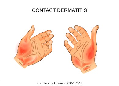 vector illustration of an allergen on the skin. Allergy, dermatology