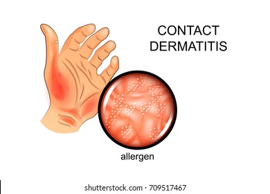 vector illustration of an allergen on the skin. Allergy, dermatology