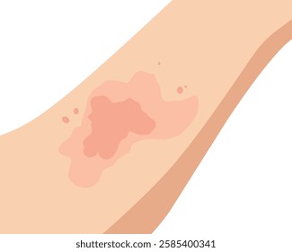Vector illustration of an allergic reaction on the skin, showing red rashes and irritation
